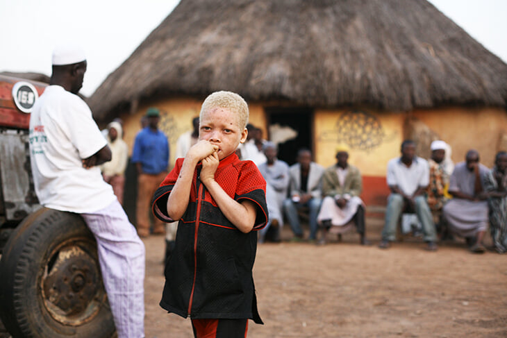 «На людей не должны охотиться, как на животных». В Танзании убивают и калечат альбиносов – бороться им помогает футбол